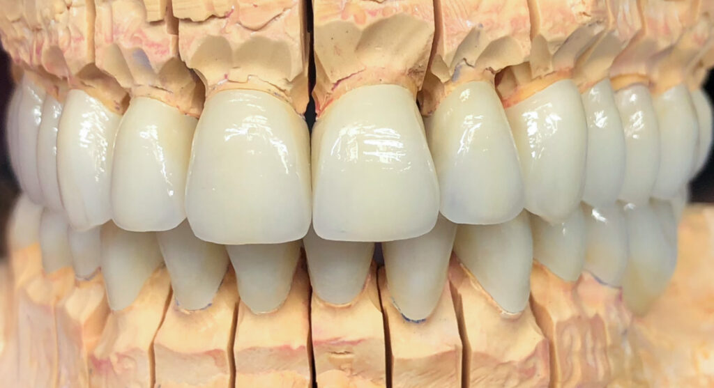 Manuelle Gesamtrehabilitation aus Presskeramik – Dentallabor Hennigsdorf