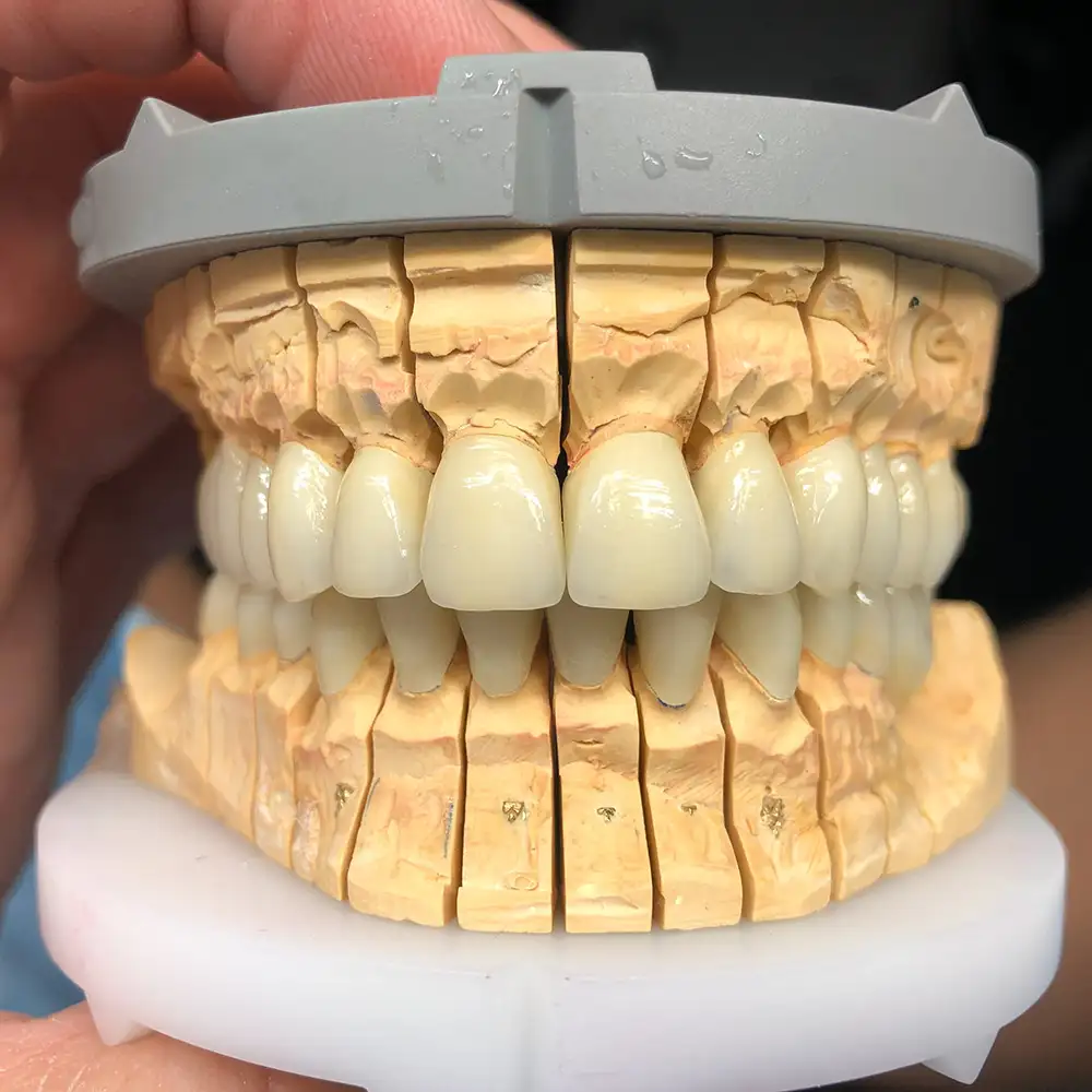 Festsitzender Zahnersatz aus Keramik auf einem Gipsmodell zur Funktionsprüfung im Artikulator.