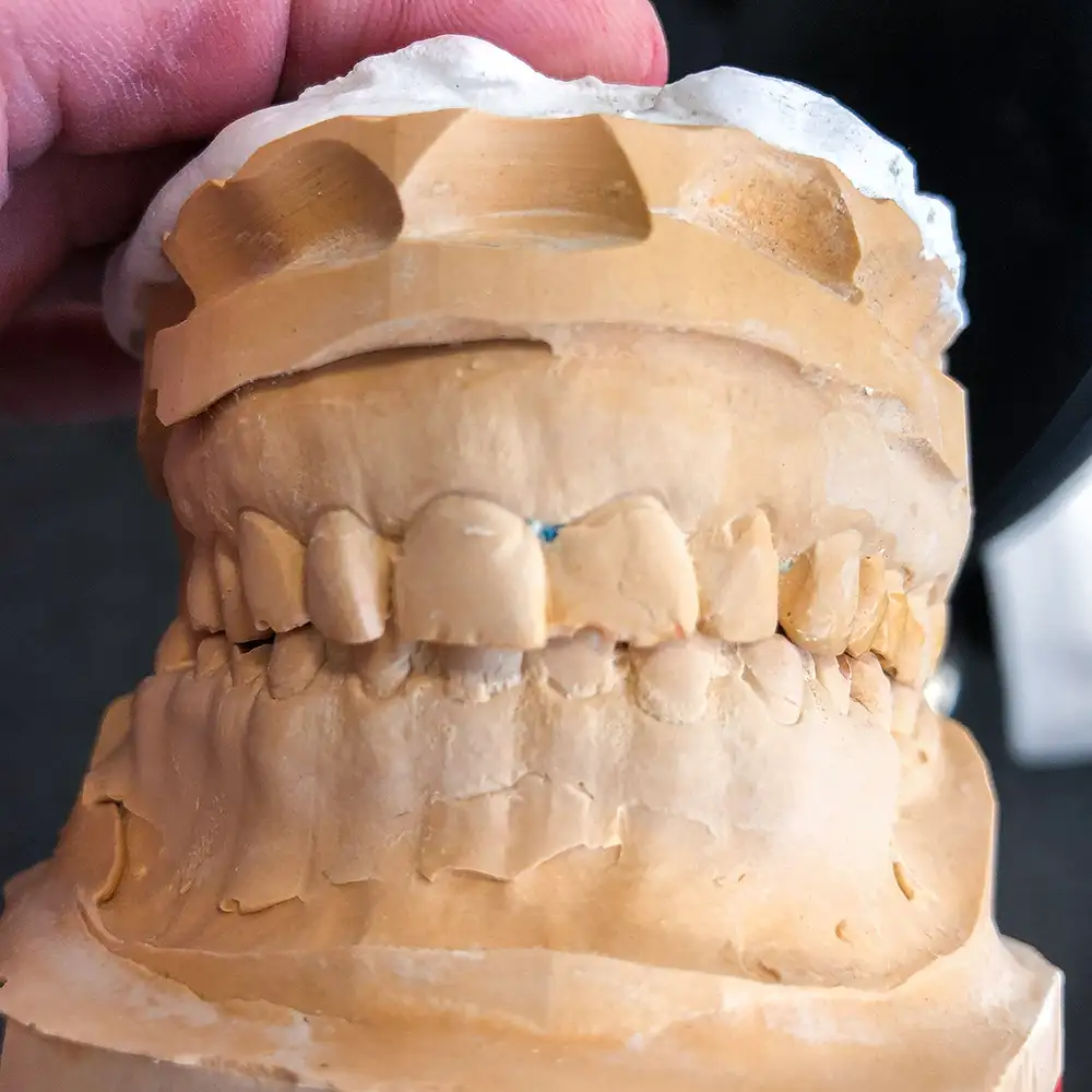 Gipsmodell der Ausgangssituation für eine Gesamtrehabilitation mit festsitzendem Zahnersatz.