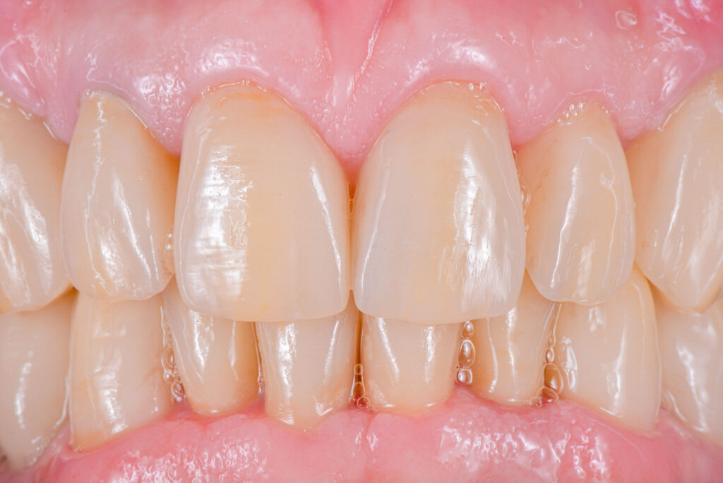 Ästhetische Frontzahn-Rehabilitation im Oberkiefer, gefertigt im Dentallabor Hennigsdorf bei Berlin.