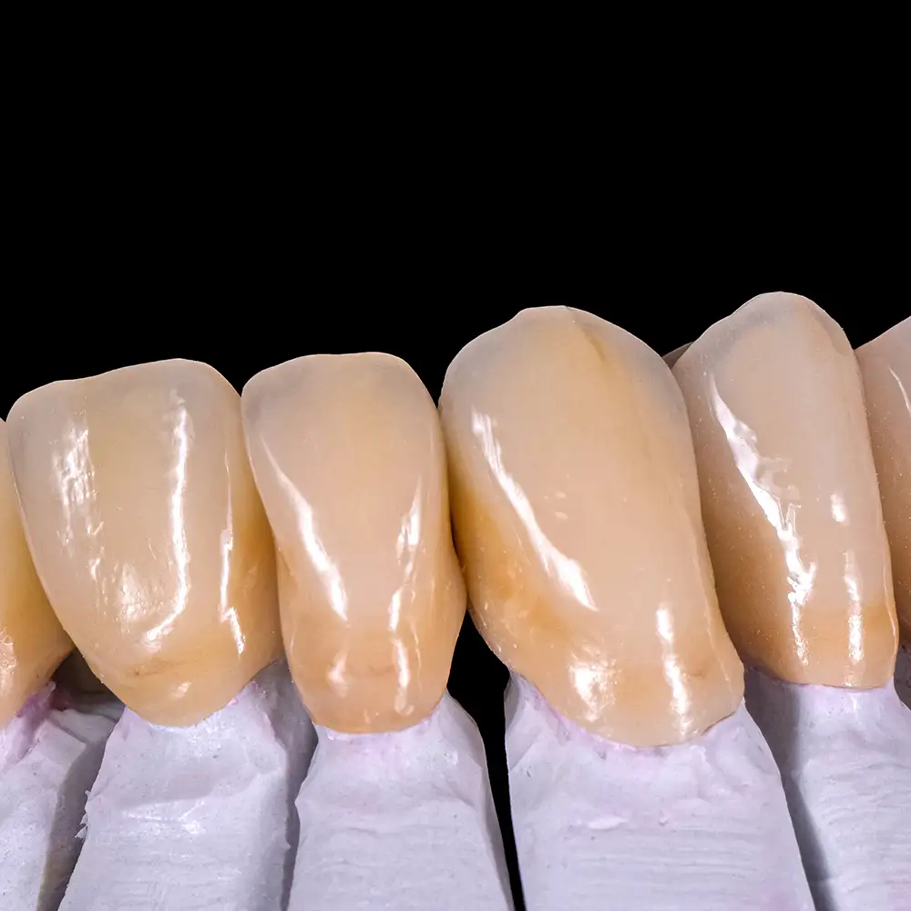 Detailaufnahme von hochästhetischen Vollkeramikkronen auf einem Zahnmodell, gefertigt von Kes Carpenter in Hennigsdorf.