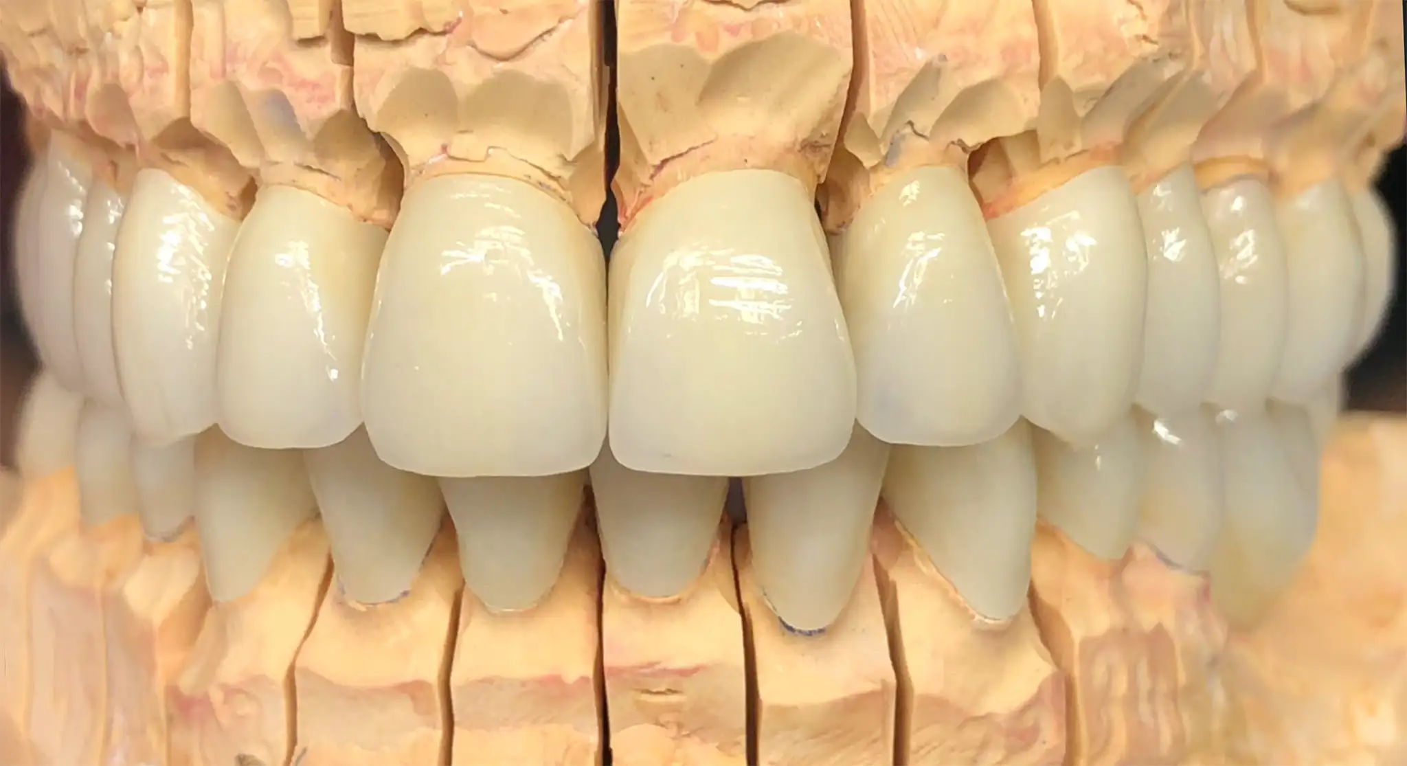 Frontale Ansicht der fertigen keramischen Gesamtrehabilitation für Oberkiefer und Unterkiefer.